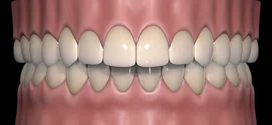 3D realistic rendering of overbite